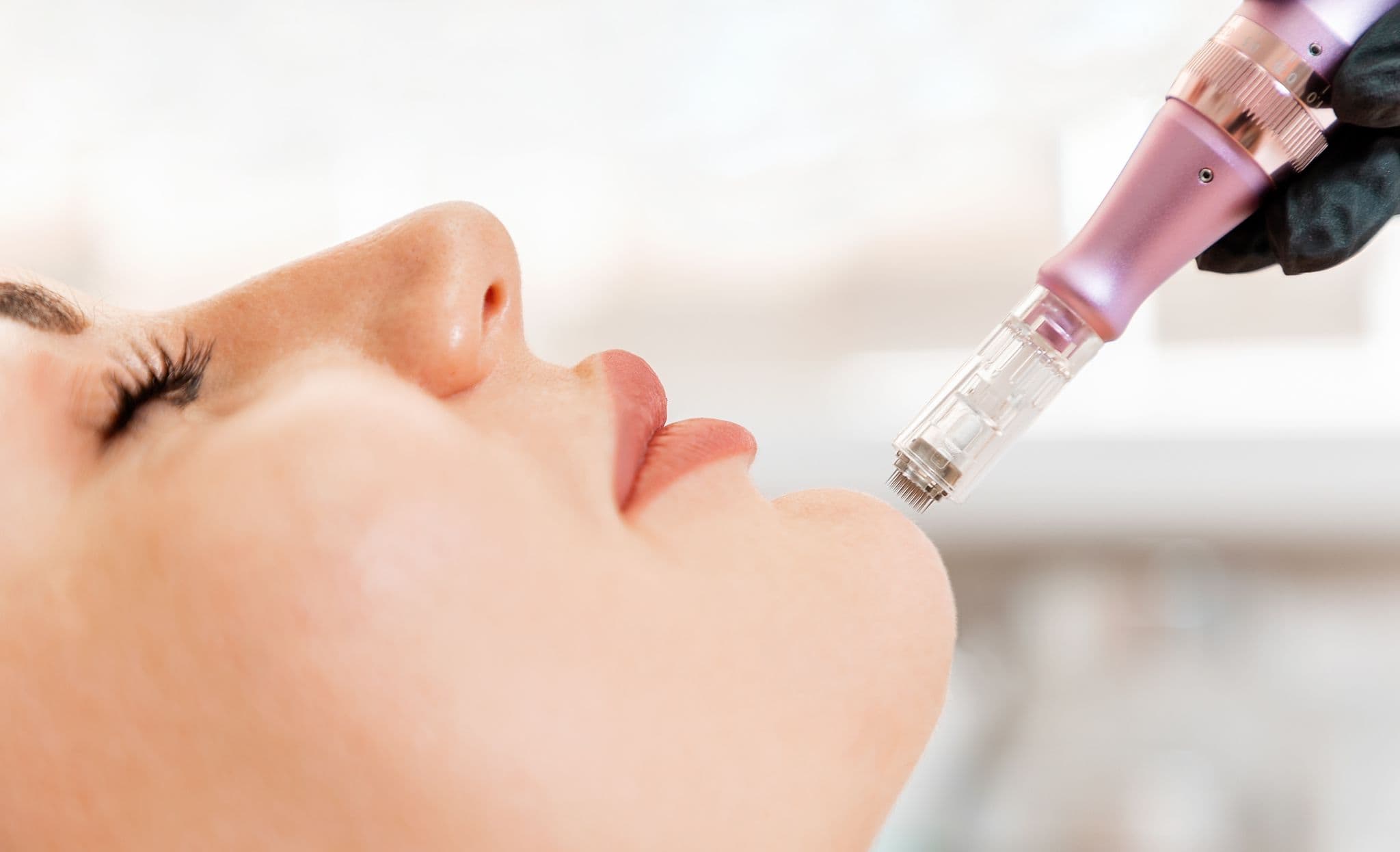 Microneedling